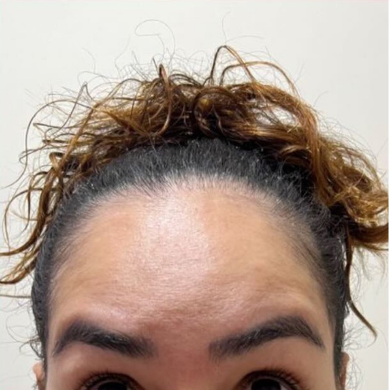 Depois — testa lisa após aplicação de botox