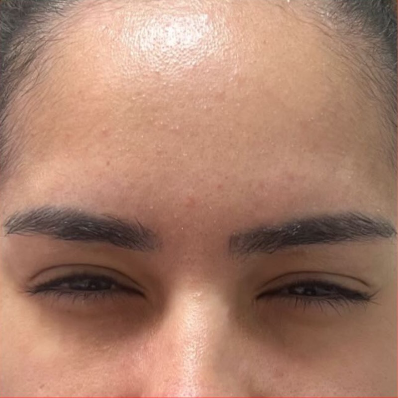 Depois — glabela lisa após aplicação de botox